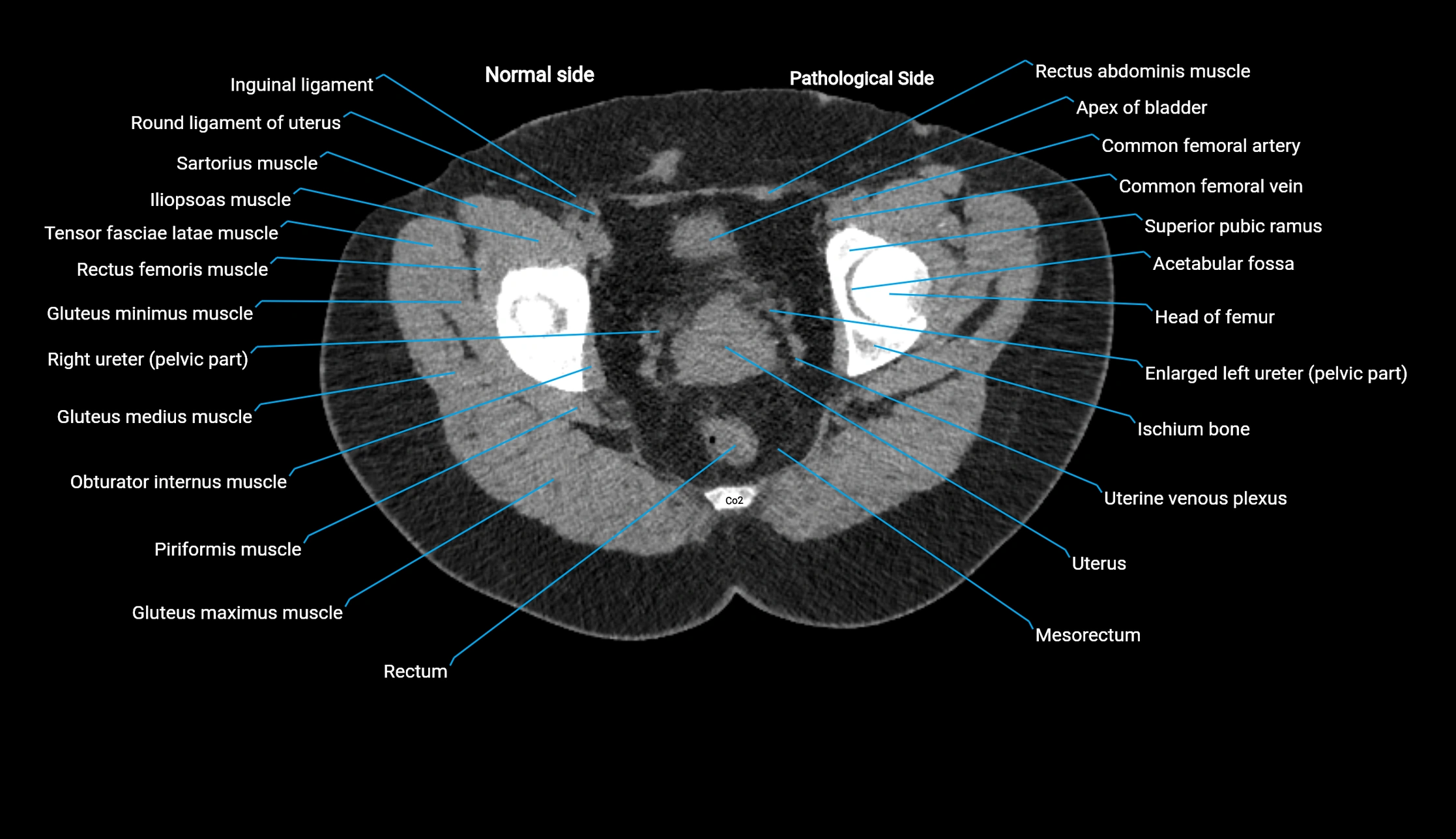 CT KUB axial cross sectional anatomy  radiology image -img-00201-00154.webp